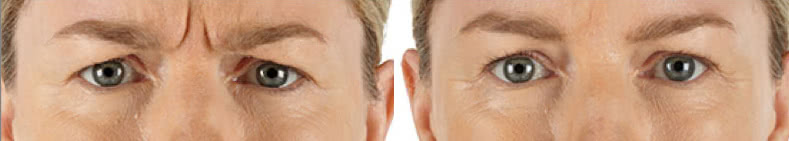 Before & after xeomin | Ideal Wellness & Aesthetics