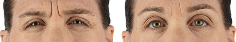 Before & after xeomin | Ideal Wellness & Aesthetics