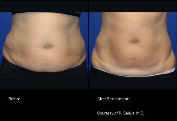 FlexSure before and after | Ideal Wellness & Aesthetics