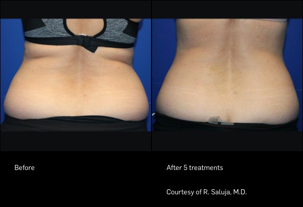 FlexSure before and after | Ideal Wellness & Aesthetics