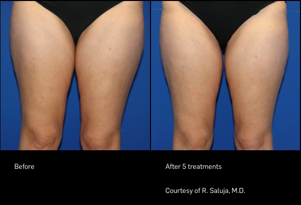 FlexSure before and after | Ideal Wellness & Aesthetics