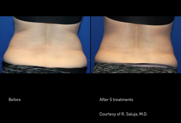 FlexSure before and after | Ideal Wellness & Aesthetics