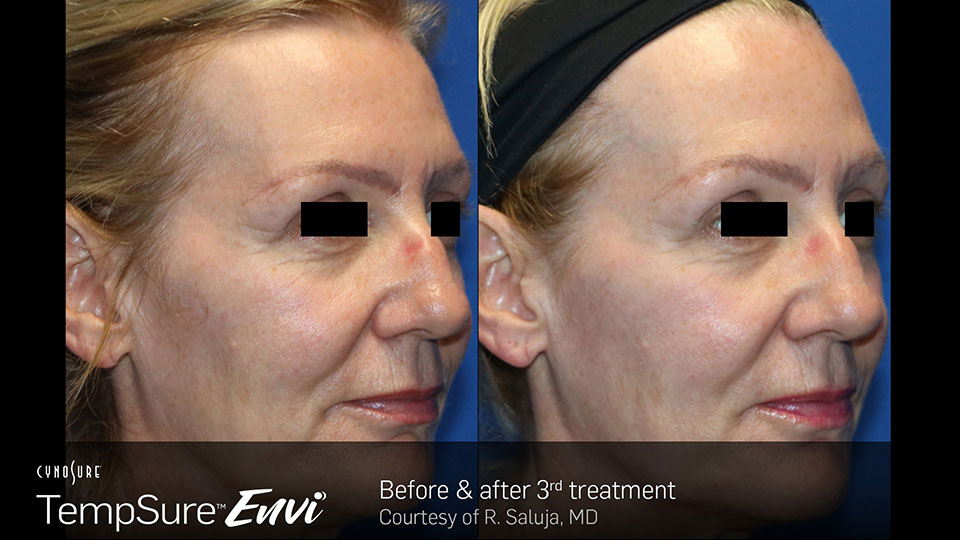 TempSure envi before and after | Ideal Wellness & Aesthetics