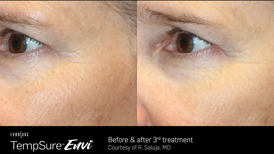 TempSure envi before and after | Ideal Wellness & Aesthetics