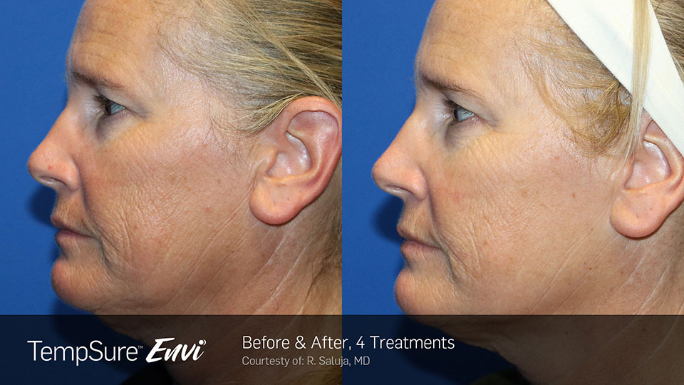 TempSure envi before and after | Ideal Wellness & Aesthetics