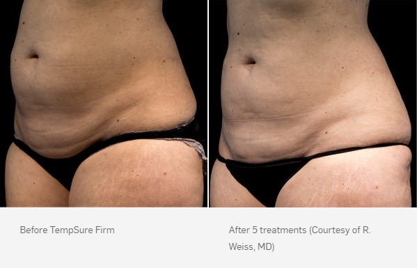 TempSure Firm Before & After | Ideal Wellness & Aesthetics