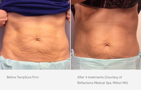 TempSure Firm Before & After | Ideal Wellness & Aesthetics