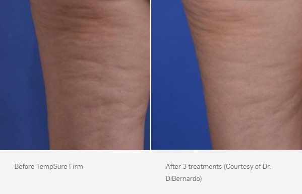 TempSure Firm Before & After | Ideal Wellness & Aesthetics