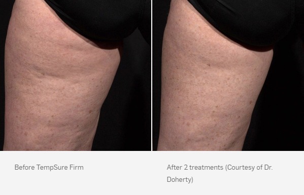 TempSure Firm Before & After | Ideal Wellness & Aesthetics