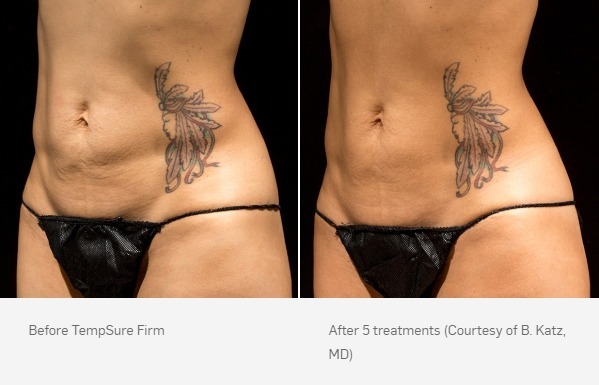 TempSure Firm Before & After | Ideal Wellness & Aesthetics