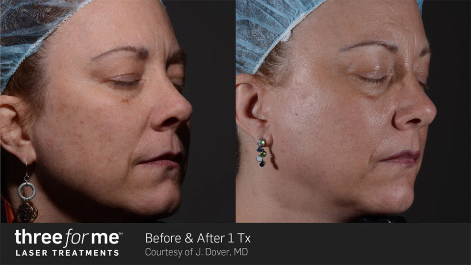 Three for me before & after | Ideal Wellness & Aesthetics