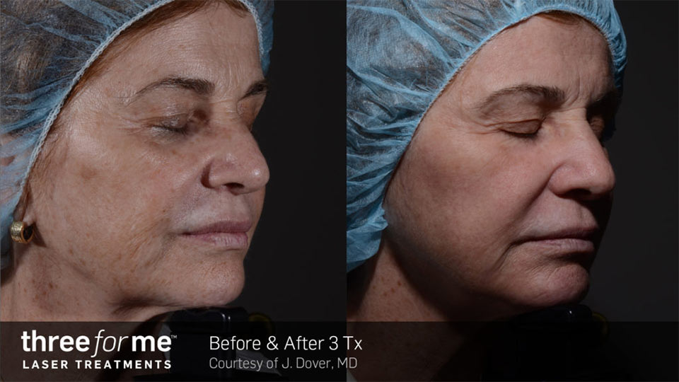 Three for me before & after | Ideal Wellness & Aesthetics